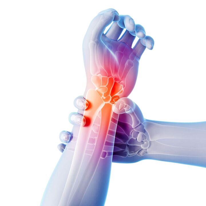 Arthroza