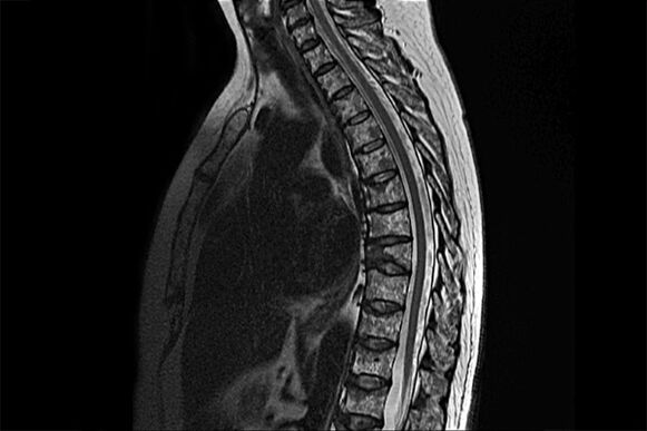 Manifestacije torakalne osteohondroze v podobi MRI