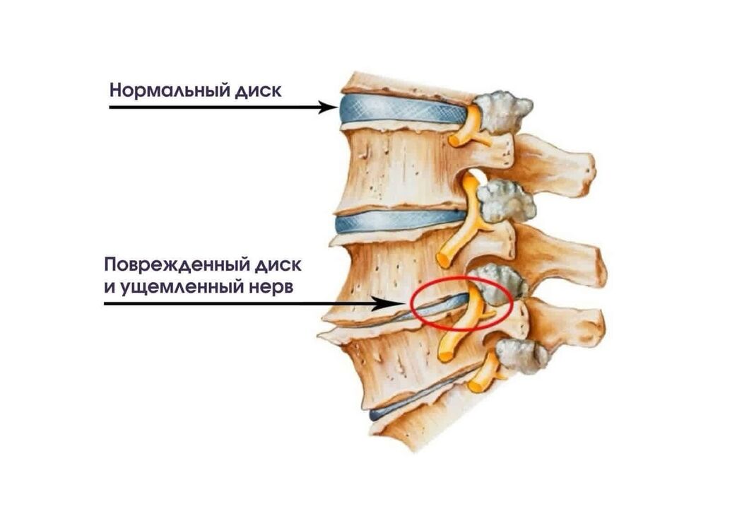 Simptomi osteohondroze materničnega vratu
