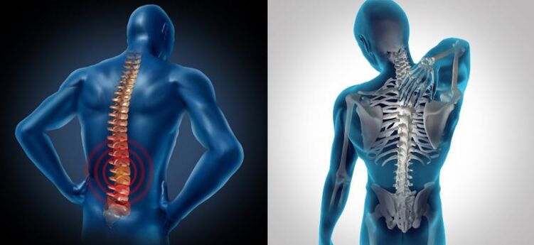 Vnetje v hrbtenični osteohondrozi