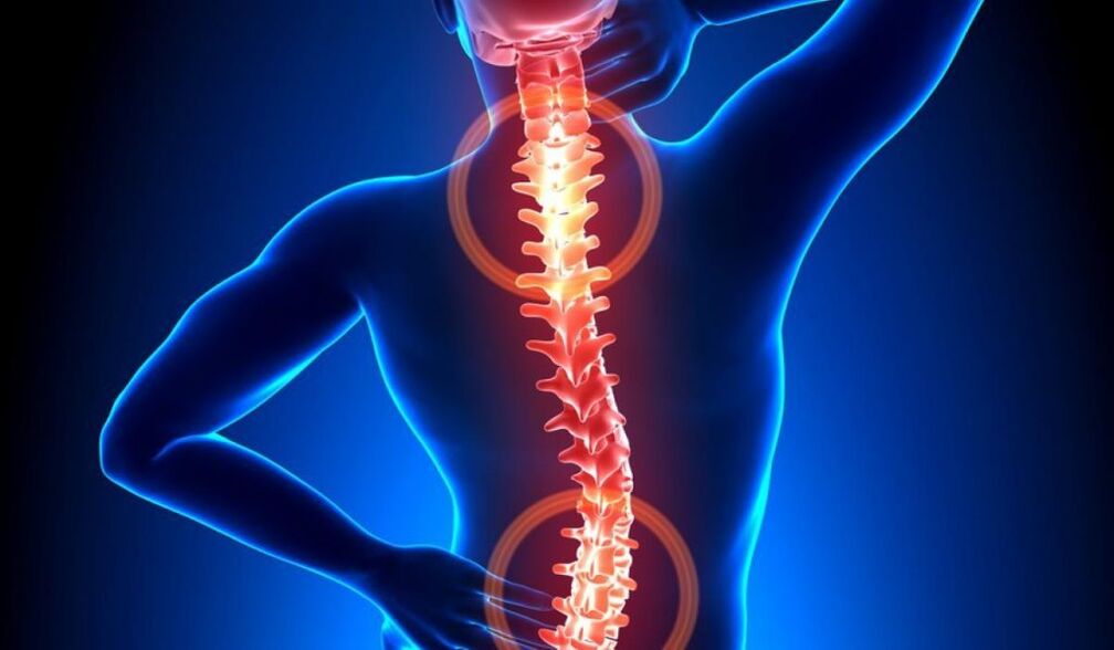 osteohondroza hrbtenice