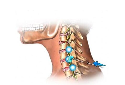 zdravljenje cervikalne osteohondroze